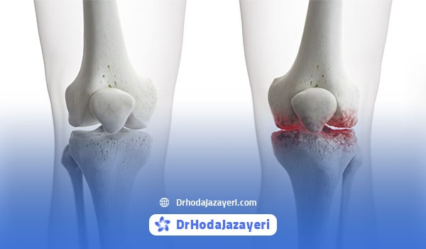 عکس آرتروز زانو شدید