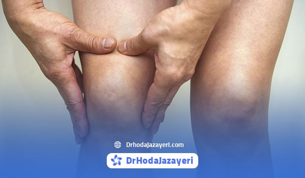 استئوآرتریت یکی از شایع ترین انواع آرتروز زانو در زنان