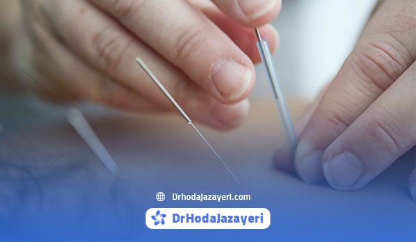 موارد استفاده از طب سوزنی با نخ