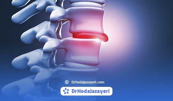 بیرون زدگی دیسک کمر