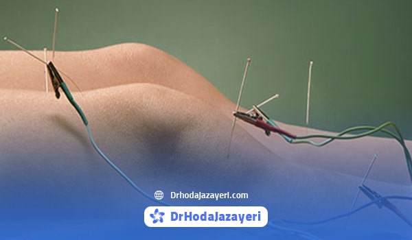 طب سوزنی الکتریکی برای زانو