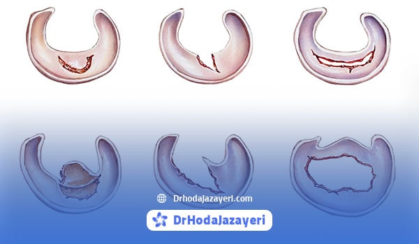 انواع پارگی مینیسک زانو