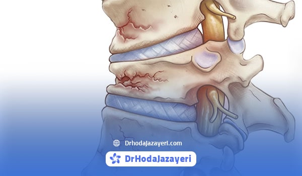 تغییر شکل ستون فقرات از علائم پوکی استخوان