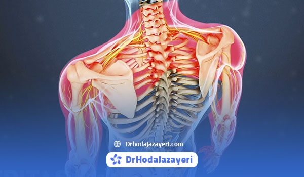 آسیب نخاعی به واسطه بیرون زدگی دیسک گردن