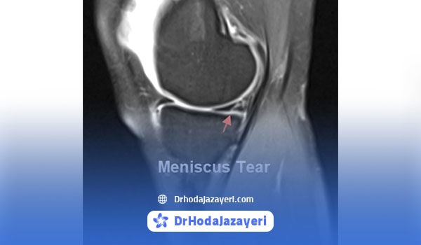 عکس ام آر آی پارگی مینیسک زانو