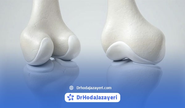 مزایای طب سوزنی برای آرتروز زانو