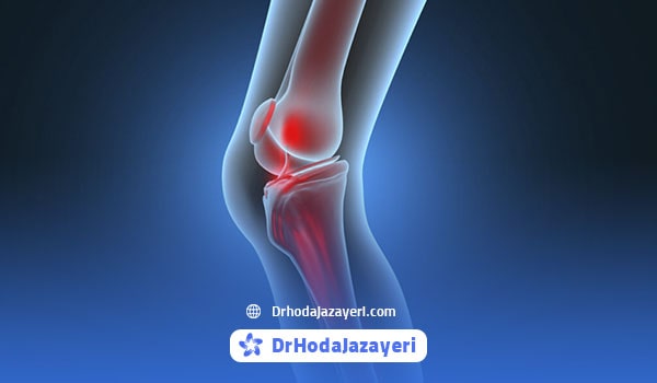 پارگی مینیسک زانو از دلایل صدا دادن زانو