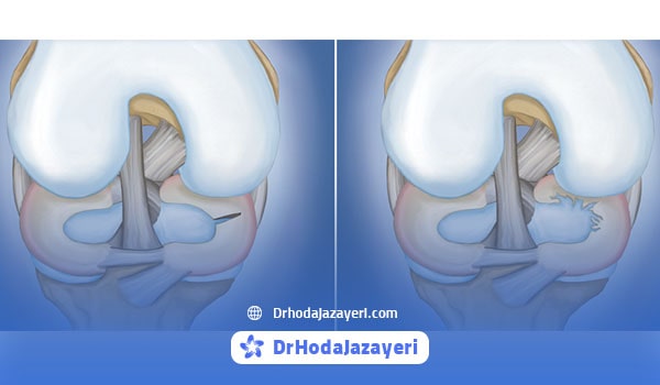 پارگی مینیسک زانو همراه با احساس درد، سفتی و تورم