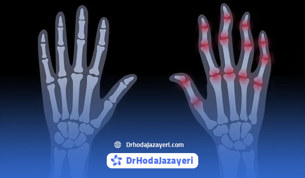 آرتروز دست و انگشتان چیست؟