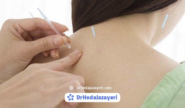 آيا طب سوزنی برای ديسک گردن مفيد است؟ فواید طب سوزنی برای دیسک گردن