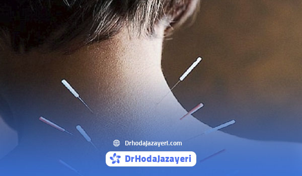 انواع طب سوزنی برای دیسک گردن