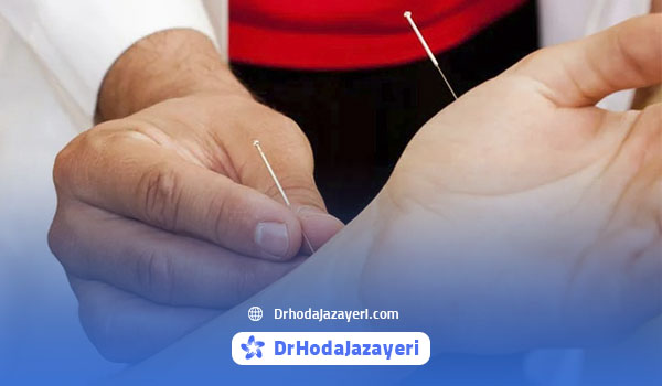 طب سوزنی برای آرتروز دست و انگشتان