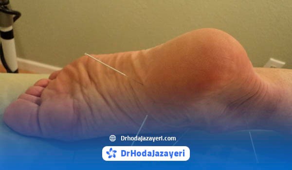 عوارض طب سوزنی برای خار پاشنه