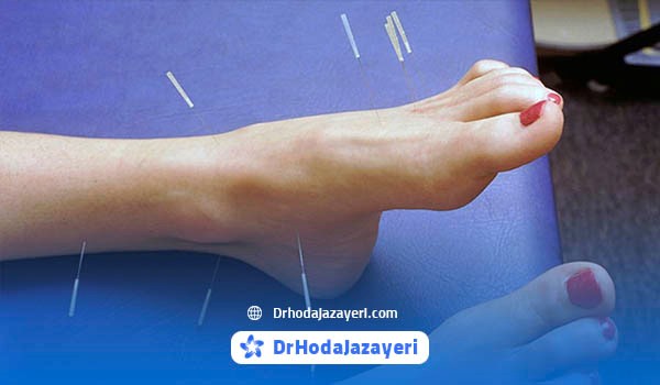 مزایای طب سوزنی برای فاشیای پلانتار