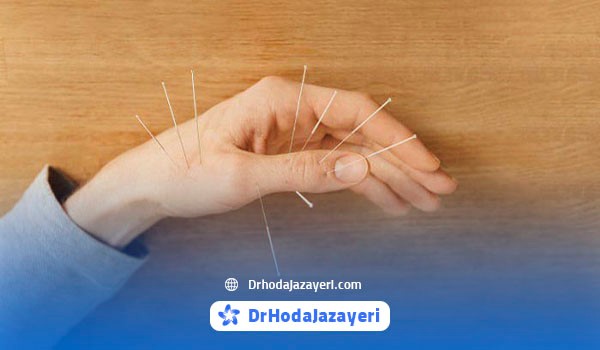 تعداد جلسات طب سوزنی برای دست به شدت و نوع بیماری مربوط است