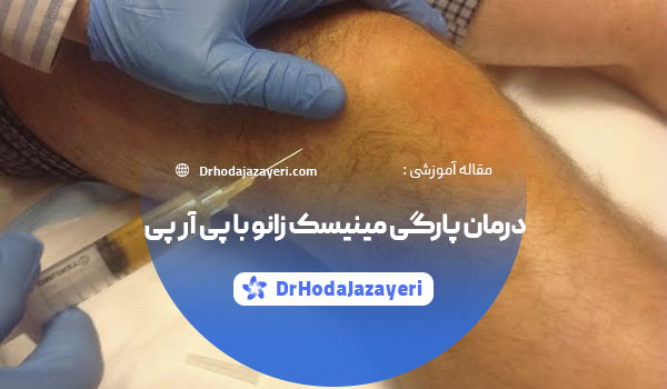 درمان پارگی مینیسک زانو با پی آر پی