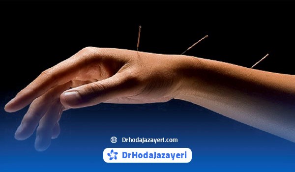 طب سوزنی برای کاهش یا تسکین درد مزمن دست