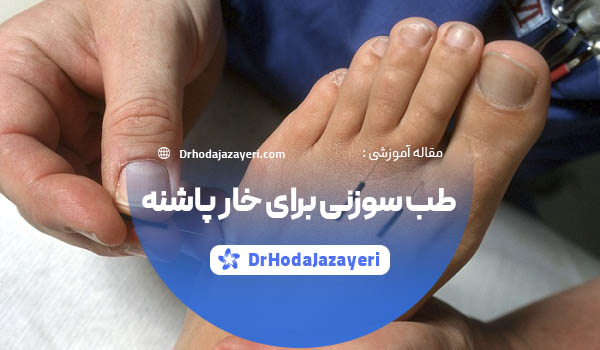طب سوزنی برای خار پاشنه