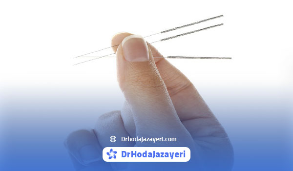 طب سوزنی برای دست
