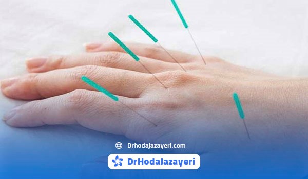طب سوزنی و مزایای آن برای بیماری های دست