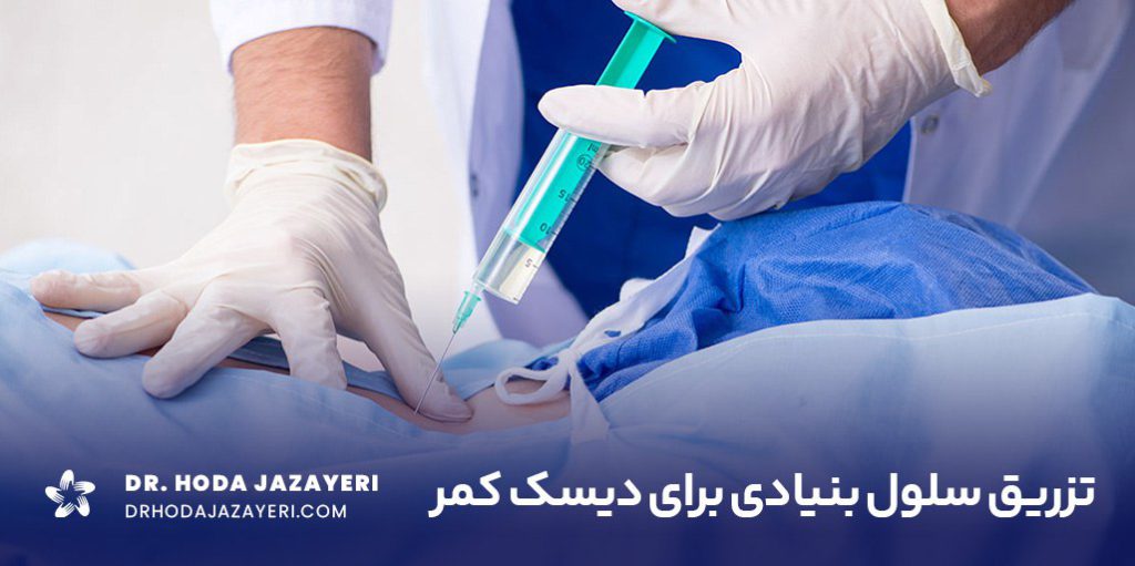 تزریق سلول بنیادی به دیسک کمر