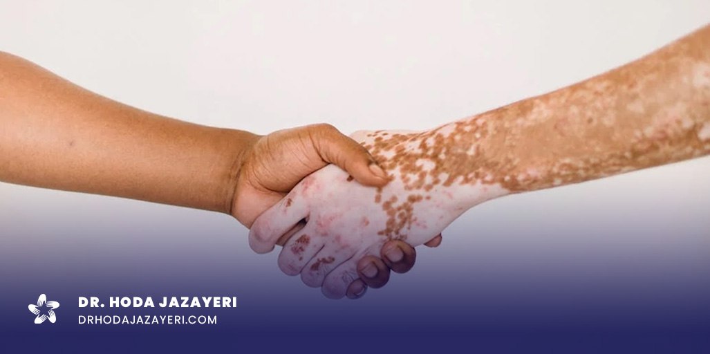 مراقبت های بعد از سلول درمانی لک و پیس