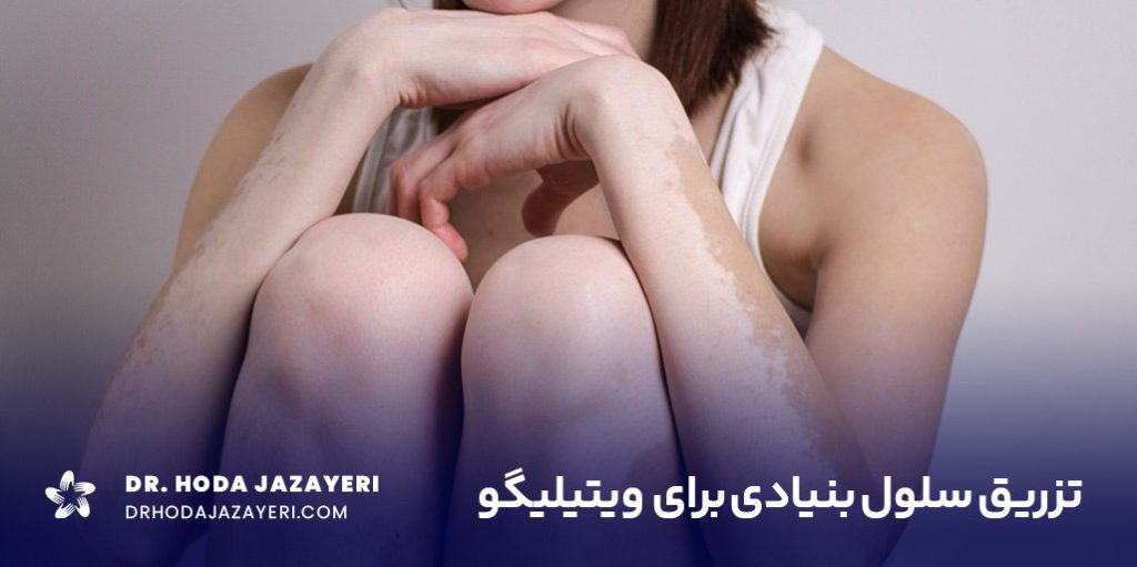 تزریق سلول بنیادی برای ویتیلیگو