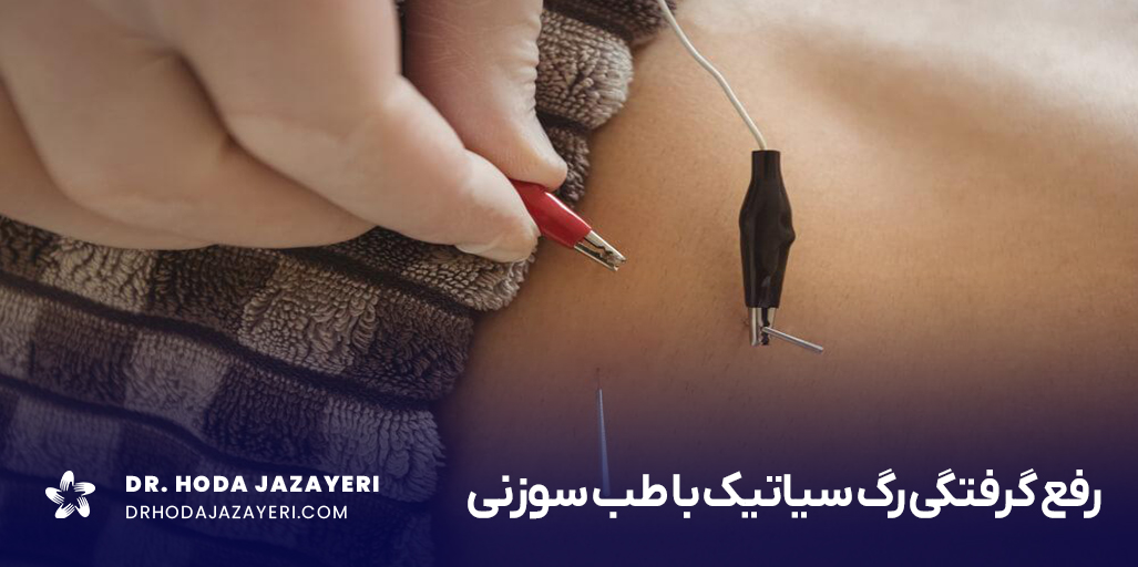 طب سوزنی برای سیاتیک چطور انجام می شود؟