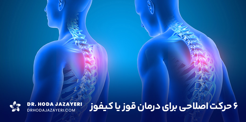 درمان قوز پشت با حرکات اصلاحی کیفوز که می توانید در خانه هم انجام دهید.