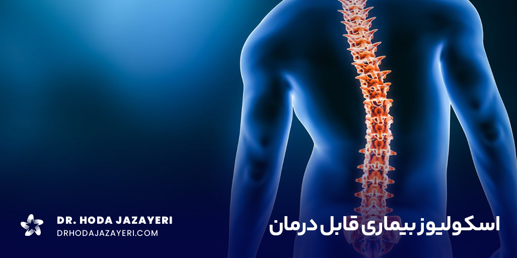 اسکولیوز یک انحراف غیرطبیعی در ستون فقرات است.