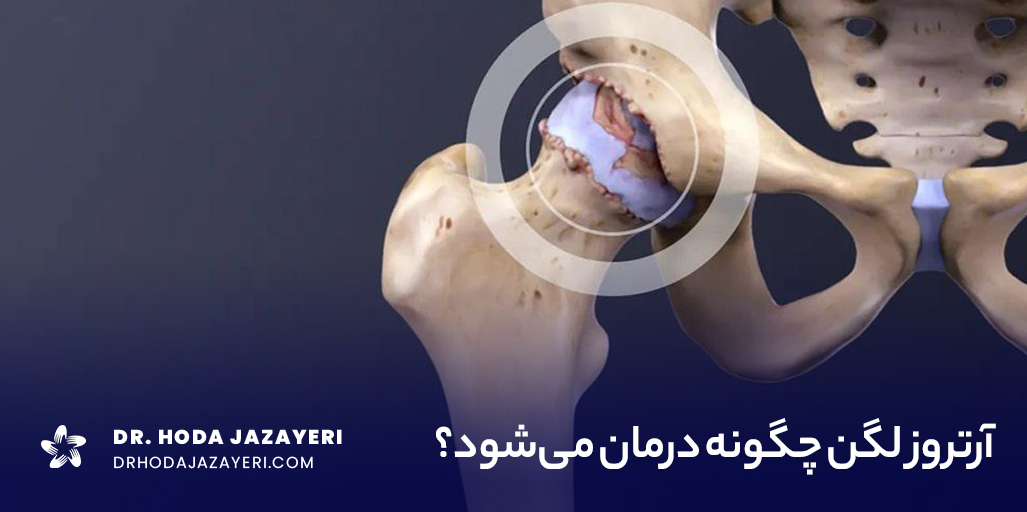 آرتروز لگن و ران این مفصل را درگیر میگند.