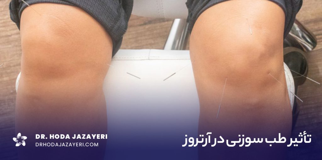 طب سوزنی برای آرتروز یک راهکار تسکینی است.