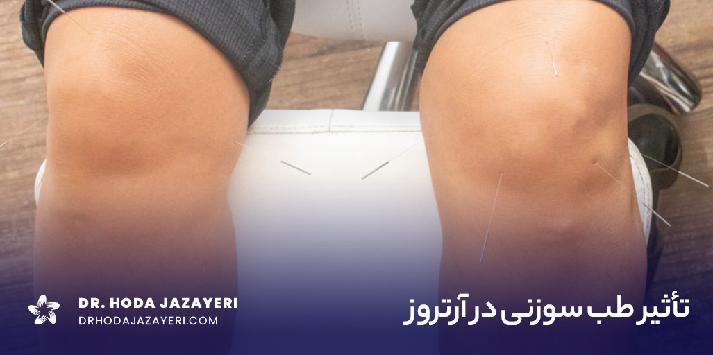 طب سوزنی برای آرتروز یک راهکار تسکینی است.