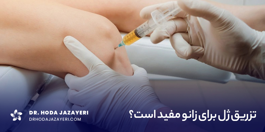 نحوه انجام تزریق ژل برای آرتروز زانو