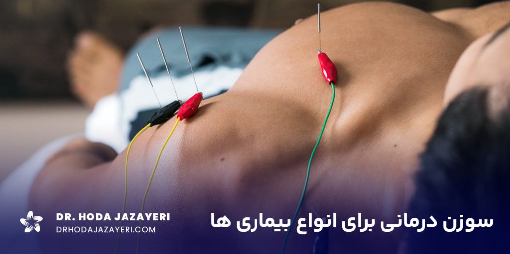 با کاربرد طب سوزنی در درمان بیماری ها آشنا شوید.