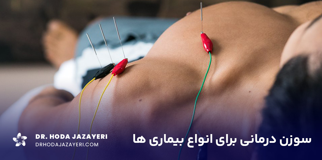 با کاربرد طب سوزنی در درمان بیماری ها آشنا شوید.