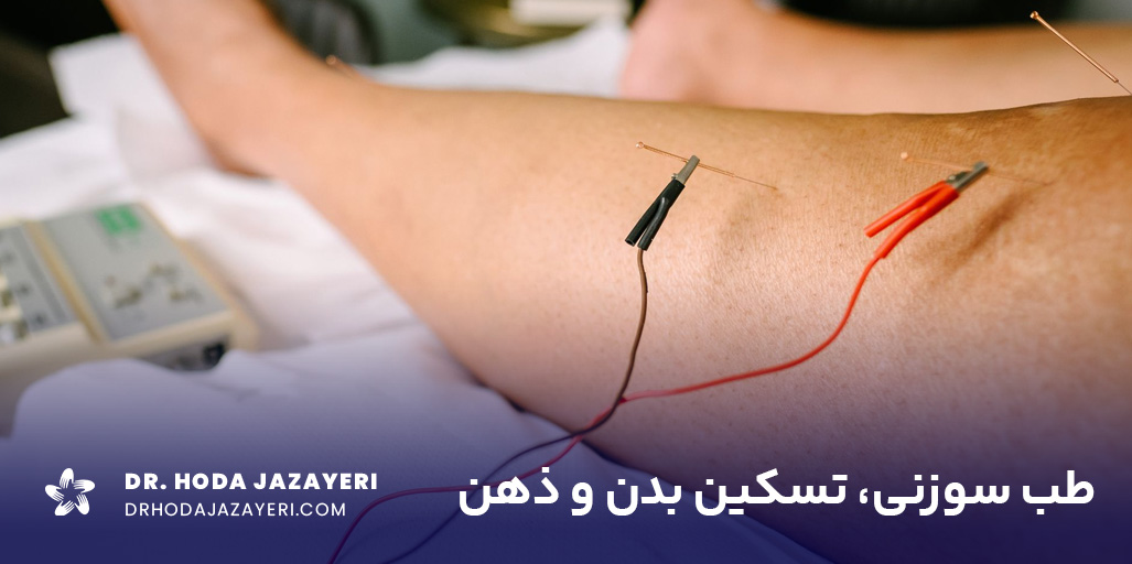 مهم ترین فواید طب سوزنی