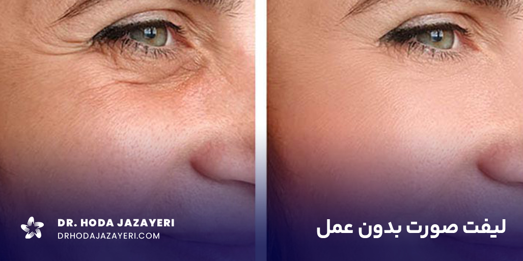 قبل و بعد از لیفت صورت